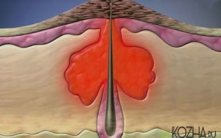 Причины появления и лечение прыщей наполненных кровью