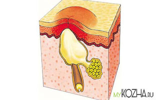 Быстрые способы избавления от воспаленных прыщей