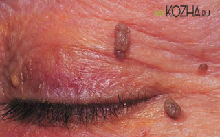 Висячие образования на коже. Необычная форма родинок или признак серьезной болезни?