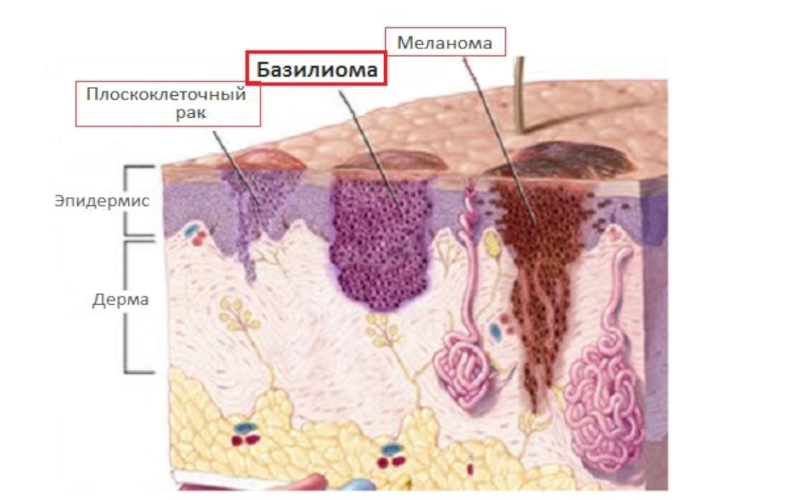 строение кожи и рост базилиомы в втканях в глубь