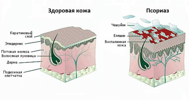 отличия здоровой кожи и пораженной псориазом, схема